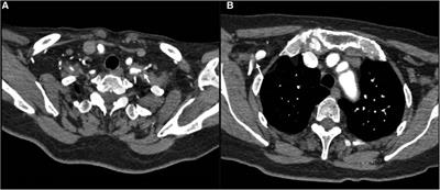 Endovascular reconstruction of bilateral upper limbs ischemia in a patient with arterial outlet syndrome: A case report and literature review